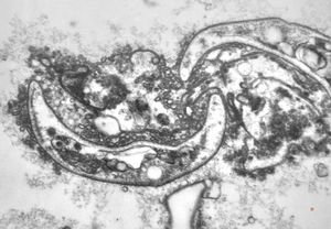 M,50y. | Pneumocystis carinii